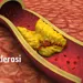 ARTERIOSCLEROSI: di cosa stiamo parlando?